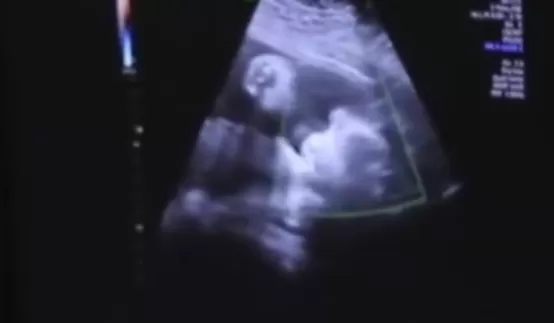 神奇 新生儿出生后右手食指现创口 原来竟是自己在妈妈肚子里嘬破的 3天后还会自行吸收结痂